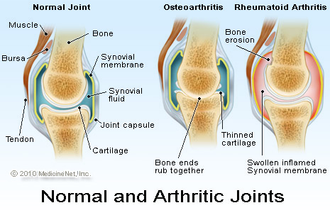 Pictures of Normal and Arthritic Joints - Rheumatoid Arthritis