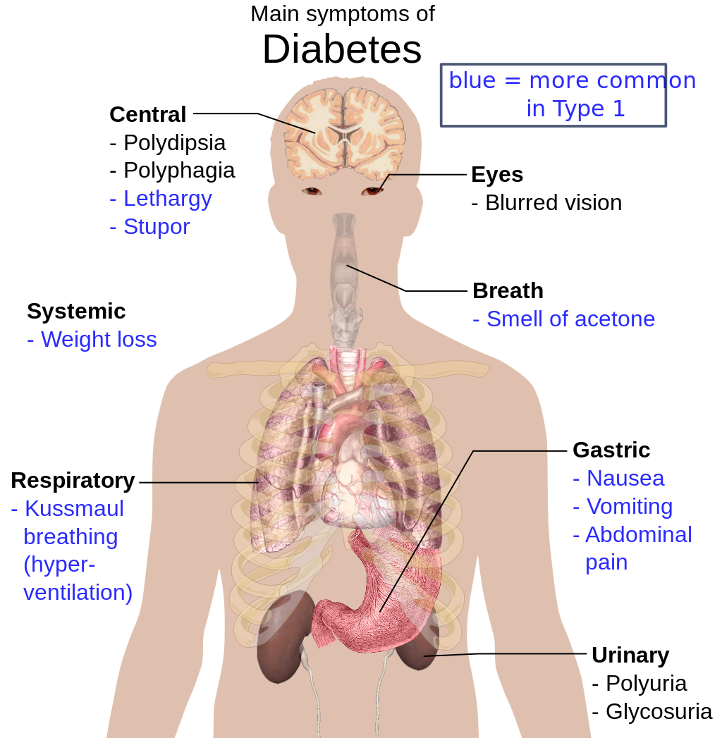 http://upload.wikimedia.org/wikipedia/commons/thumb/2/28/Main_symptoms_of_diabetes.png/300px-Main_symptoms_of_diabetes.png