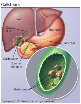 Gallstones