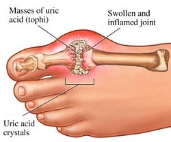 Gout disease explained