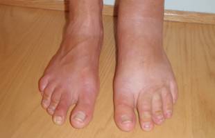 foot Lymphedema